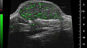 Microbubbles boosting:- The ultrasound contrast agents (microbubbles) market is driven by their role in enhancing diagnostic capabilities and revolutionising treatment methods, according to a report on Tuesday.[IANS]