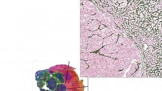  Kidney Cancer Therapy Response: An artificial intelligence (AI)-based model developed by UT Southwestern Medical Center researchers [Newswise]