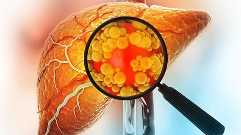 Liver Cancer Treatment: Hepatocellular carcinoma (HCC), the most common form of liver cancer [Pixabay]
