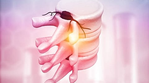 Neurosurgical Focus: The May issue of Neurosurgical Focus (Vol. 58, No. 5) presents seventeen articles on the management of spinal column tumors. [Pixabay]