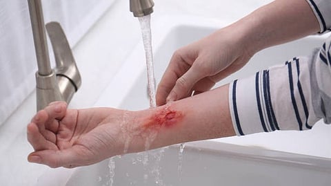 Missing evidence and limited treatment options mean deaths from burn injuries are ten times higher in poor countries compared with richer ones. [Pixabay]