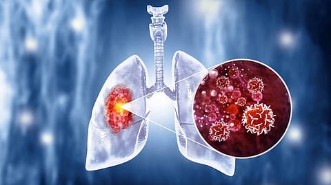 Lung Cancer Patients: Breathing in wildfire pollution may make it harder for people with lung cancer to survive [Pixabay]