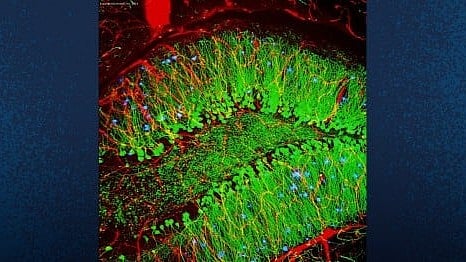 Alzheimer's Gene Therapy: Researchers at University of California San Diego School of Medicine have developed a gene therapy for Alzheimer’s disease [Newswise]