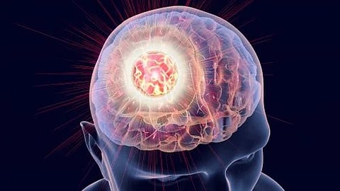 Brain Cancer: A new study led by Keck Medicine of USC researchers may have uncovered an effective combination therapy for glioblastoma [Pixabay]