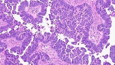 Ovarian Cancer: A new study explains the genetic underpinnings of a rare and aggressive form of ovarian cancer [Newswise]