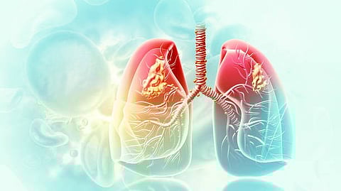 healthy lung tissue into fibrous scar tissue [Pixabay]
