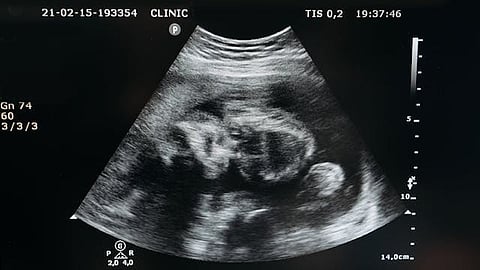 Ultrasound of pregnancy