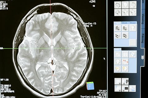 Image of MRI scan of a human brain displayed on a computer screen, showing cross-sectional details in shades of gray. Interface panels with icons on the right.