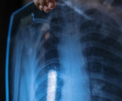 A close-up of hands holding a chest X-ray against a light source. The image shows ribs and spine in shades of blue and grey, suggesting a medical evaluation.