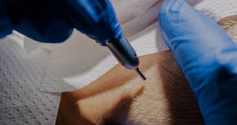 A gloved hand uses a small instrument on an ear, surrounded by a white textured surface. The scene suggests a medical or skincare procedure, conveying precision.