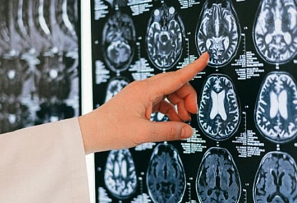 A doctor points at a brain MRI scan on a lightbox, highlighting detailed images of brain structures. The scene conveys focus and analysis in a clinical setting.