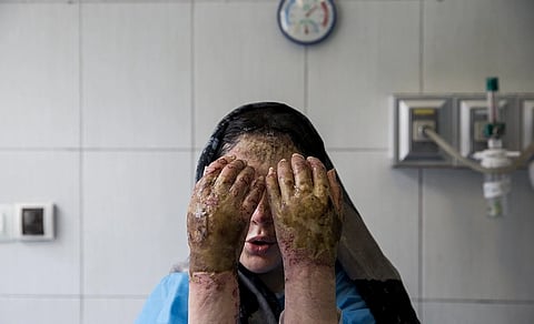 A woman with her hands and face burned in an acid attack sits in a hospital with her hands in front of her face.