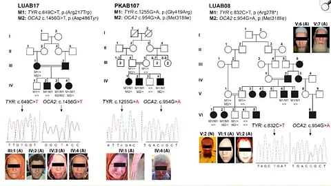 Graph from the 2021 study “Genetic Causes of Oculocutaneous Albinism in Pakistani Population.” Sajid et al., Genes 2021, 12(4), 492.