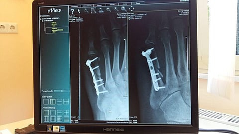 Smoking Linked to Higher Risk of Bone Fracture