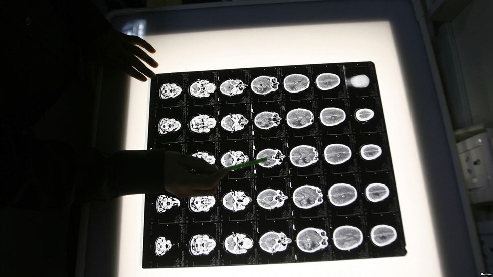 To Treat Brain Cancer Scientists Taking Polio’s Help