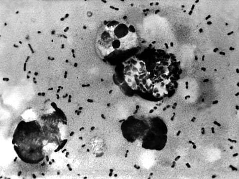 US teen dies of rare, hard to diagnose plague