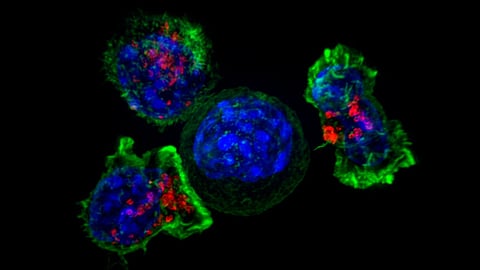 Symptoms of Cancer: कैंसर कई प्रकार के हो सकते हैं। अधिकतर लोग कैंसर की बीमारी को लेकर आज भी जागरूक नहीं है। (Wikimedia Commons)
