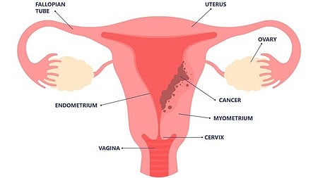 पीसीओडी 