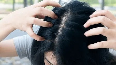 सर्दियों में सिर की खुजली से परेशान महिला अपने बाल खुरचती हुई|