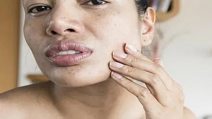 सर्दियों में रूखी और बेजान त्वचा वाली लड़की का चेहरा।