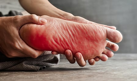 बर्निंग फीट सिंड्रोम 