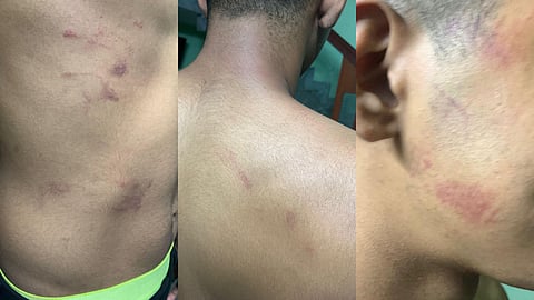 നടുവണ്ണൂരിൽ പ്ലസ് വൺ വിദ്യാർഥിക്ക് സീനിയേഴ്സിൻ്റെ മർദനം