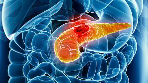 pancreas cancer