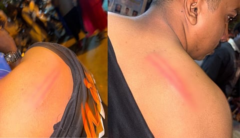 ശംഖുമുഖത്ത് പുതുവത്സര പരിപാടിക്കിടെ ലാത്തി വീശി പൊലീസ്; മൂന്ന് വിദ്യാര്‍ഥികള്‍ക്ക് പരിക്ക്