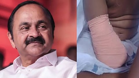 പാലക്കാട് ജില്ലാ ആശുപത്രിയിലെ ചികിത്സാ പിഴവ്: വിനോദിനിക്ക് കൈവച്ച് നൽകും; വാഗ്ദാനവുമായി വി.ഡി. സതീശൻ