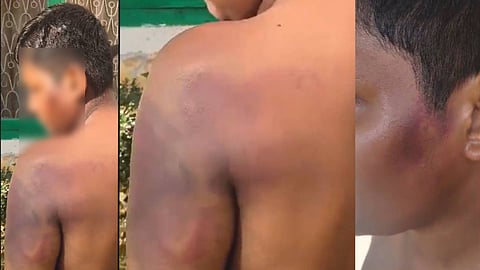 പണം മോഷ്ടിച്ചെന്ന് ആരോപണം; ഭിന്നശേഷി വിദ്യാർഥിക്ക് അധ്യാപകൻ്റെ ക്രൂര മർദനം