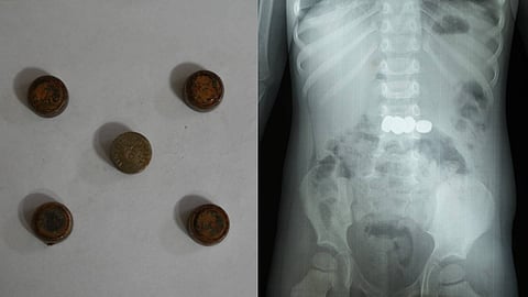 കുഞ്ഞിൻ്റെ വയറ്റിൽ നിന്നും പുറത്തെടുത്ത ബാറ്ററികൾ