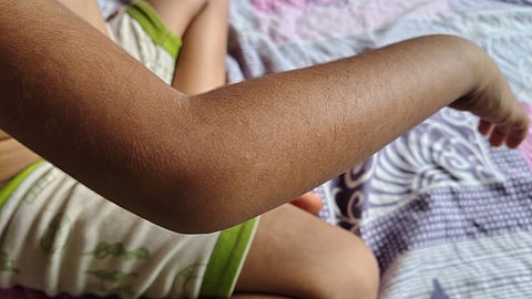 സ്റ്റീൽ സ്കെയില് കൊണ്ട് കയ്യിൽ അടിച്ചു; കോഴിക്കോട് നാല് വയസുകാരനെ അങ്കണവാടി ടീച്ചറുടെ മർദനം