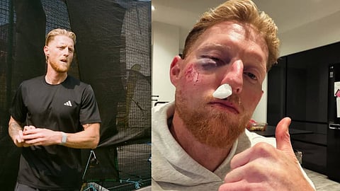 കണ്ണിലും മൂക്കിലും ചതവും മുറിവും; പരിശീലനത്തിനിടയില്‍ പരിക്കേറ്റ ചിത്രം പങ്കുവെച്ച് ബെന്‍ സ്റ്റോക്‌സ് 