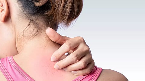 പകരുന്നതല്ല ചൂടുകുരു! ശ്രദ്ധിക്കാം.. തടയാം.. അറിയേണ്ടതെല്ലാം