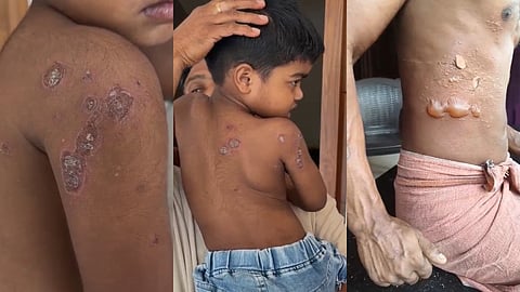 ചുട്ടുപൊള്ളി സംസ്ഥാനം... മലപ്പുറത്ത് കുട്ടികൾക്കും യുവാവിനും സൂര്യാതപമേറ്റു