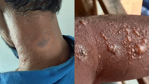 കൊടും ചൂടിൽ ഉരുകി കേരളം; ഇന്ന് സൂര്യാഘാതമേറ്റ് രണ്ട് മരണമെന്ന് സംശയം; വടക്കൻ കേരളത്തിൽ വ്യാപകമായി സൂര്യാതപമേറ്റ് പരിക്ക്