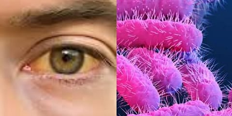 മലപ്പുറം ജില്ലയിൽ  മഞ്ഞപ്പിത്ത രോഗബാധിതരുടെ എണ്ണം വർധിക്കുന്നു