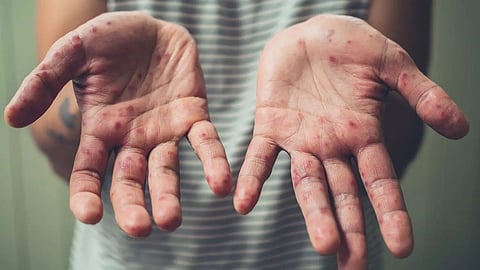 പനിയോടൊപ്പം വ്രണങ്ങളും കുമിളകളും; എന്താണ് കുട്ടികളില്‍ കാണുന്ന കൈ, കാല്‍, വായ് രോഗം?