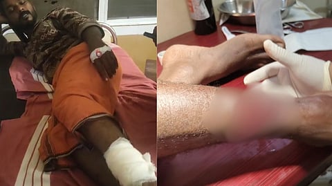 കഞ്ചാവ് വില്‍പ്പനയുമായി ബന്ധപ്പെട്ട തര്‍ക്കം; കോഴിക്കോട് കൊയിലാണ്ടിയില്‍ യുവാവിനെ വെട്ടിപ്പരുക്കേല്‍പ്പിച്ചു