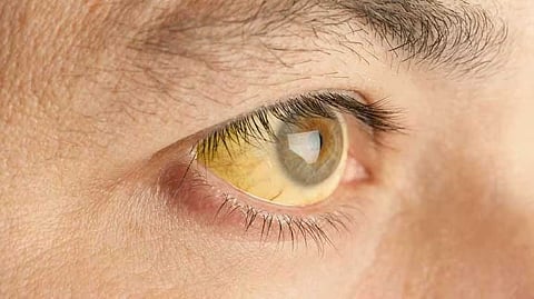 കോഴിക്കോട് ജില്ലയില്‍ മഞ്ഞപിത്തം വ്യാപിക്കുന്നു;ഈ മാസം റിപ്പോർട്ട് ചെയ്തത്  80  കേസുകൾ