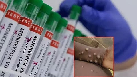 குரங்கம்மை அறிகுறி