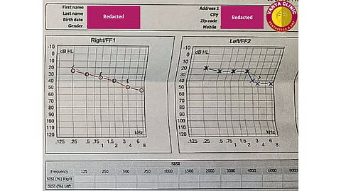 Audiometry results after hearing loss treatment in Delhi by Dr. Purodha Prasad
