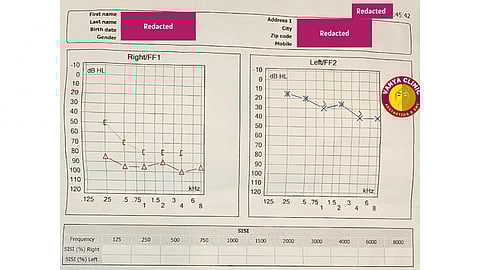 Audiometry results of Right Ear Hearing Loss in Delhi before the treatment by Dr. Purodha Prasad