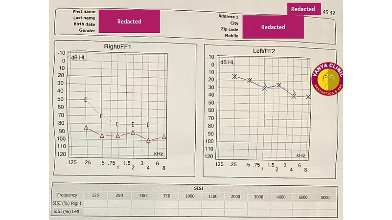 Audiometry results of Right Ear Hearing Loss in Delhi before the treatment by Dr. Purodha Prasad