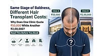 Same Stage of Baldness, Different Hair Transplant Costs: Why Does One Clinic Quote Rs 50,000 While Another Rs 2,00,000? Read This Before You Book Same Stage of Baldness, Different Hair Transplant Costs: Why Does One Clinic Quote Rs 50,000 While Another Rs 2,00,000? Read This Before You Book