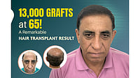 65-Year-Old, 13,000 Grafts Implanted In A Single Session: An Insight Into A Remarkable Hair Transplant Procedure 65-Year-Old, 13,000 Grafts Implanted In A Single Session: An Insight Into A Remarkable Hair Transplant Procedure