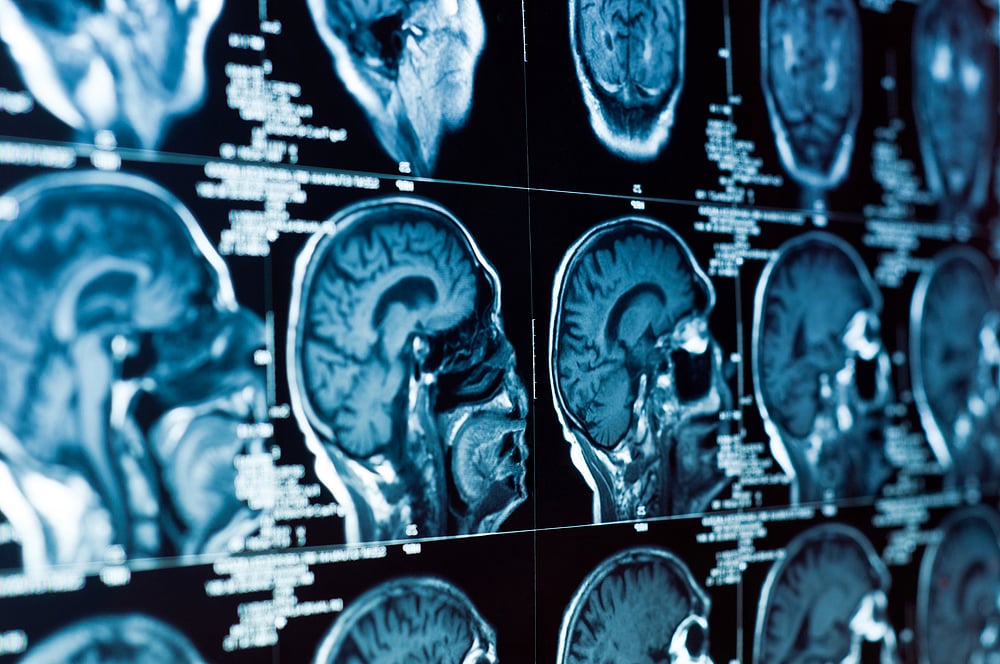 Health Insurance Claims Witness An Increase In Brain Tumours