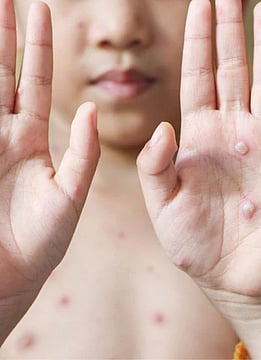 There Is A 'Tomato Flu' Outbreak In India - Here's What You Need To Know