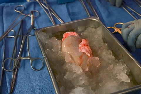A pig kidney sits on ice, awaiting transplantation into a living human at Massachusetts General Hospital.