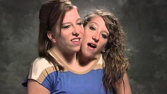 Conjoined Twin Abby Hensel Secretly Married Two Years Ago. Who Is Her Army Veteran Husband? 